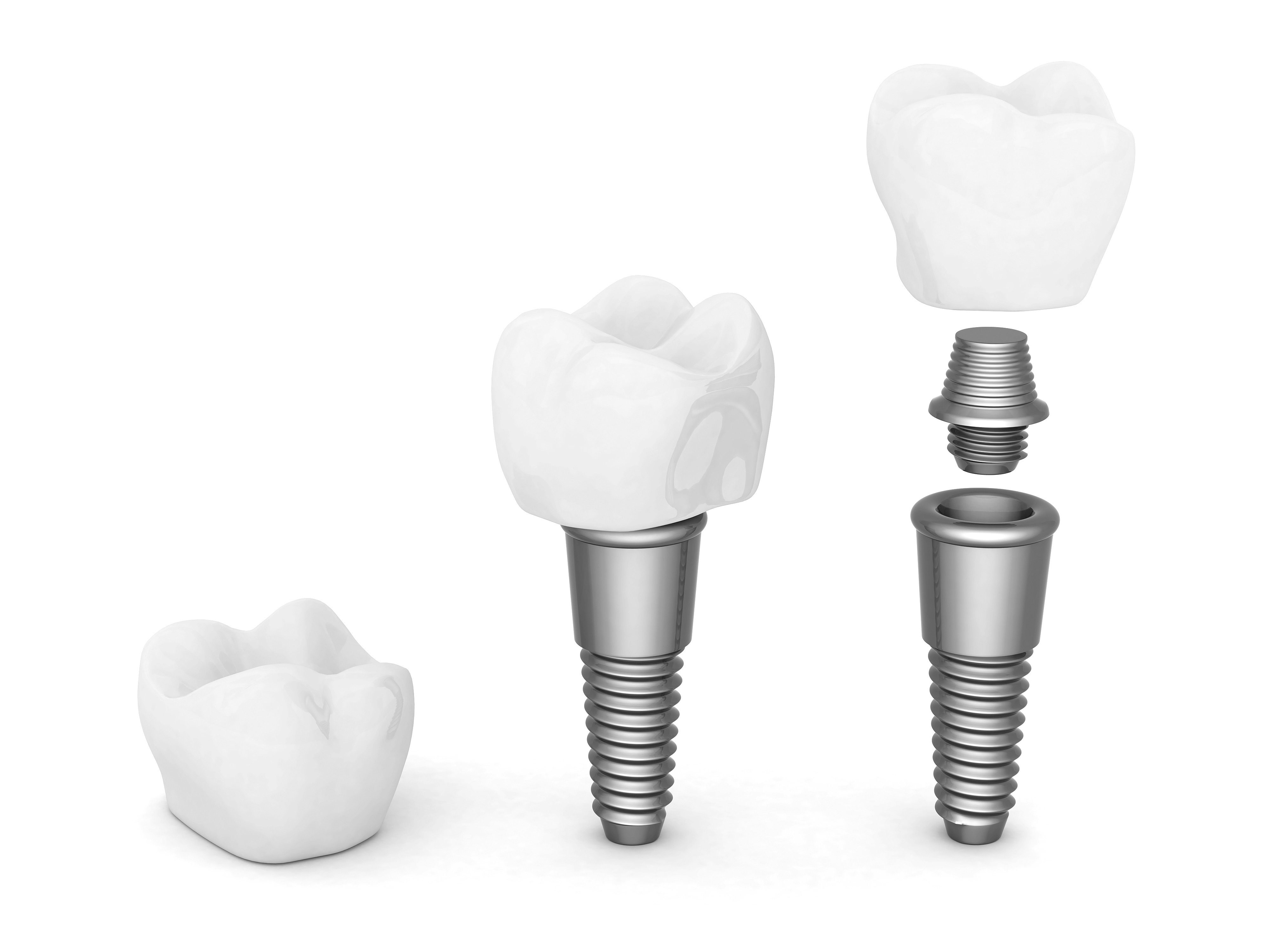 the parts of dental tooth implants