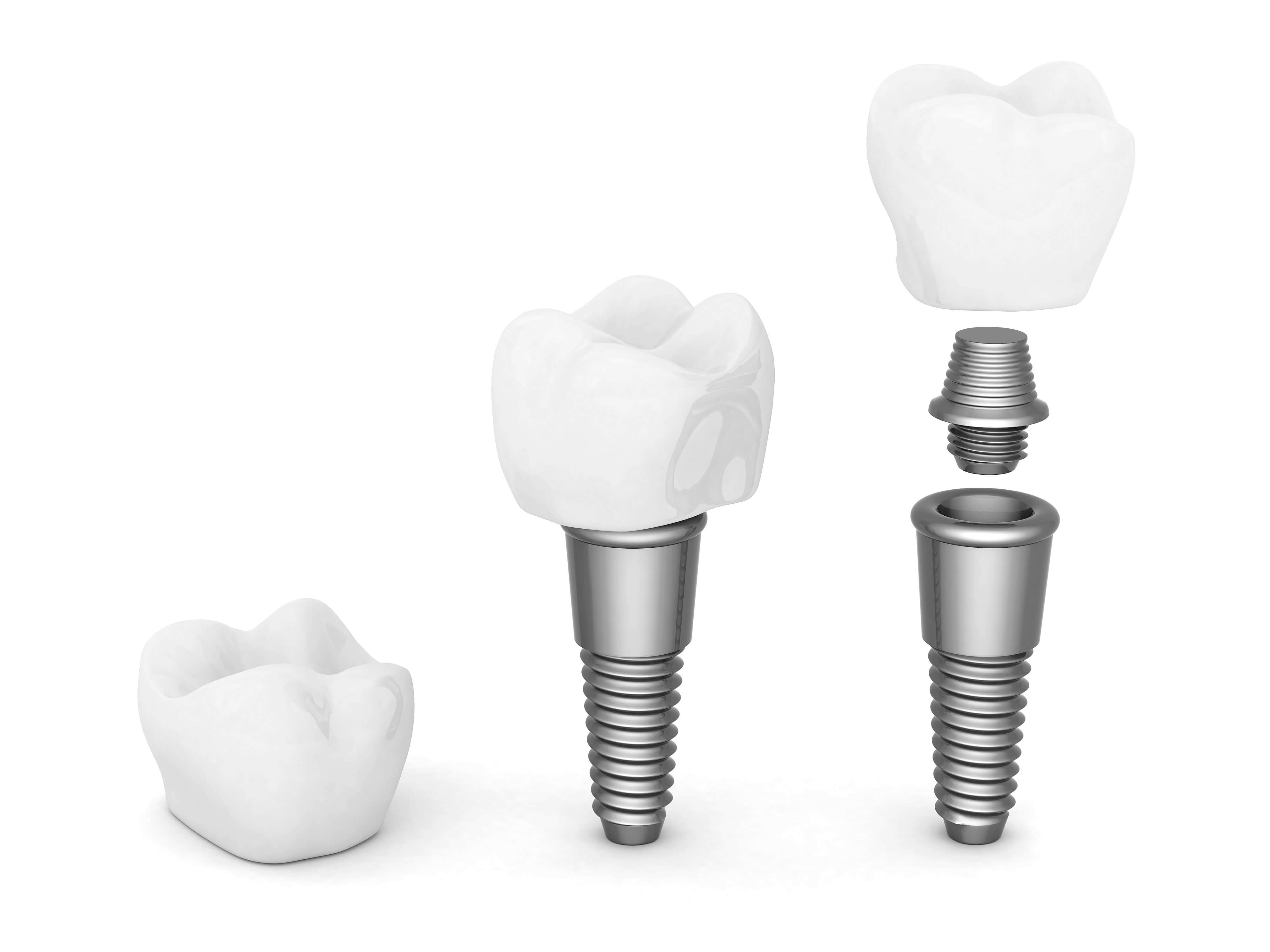 the parts of dental tooth implants