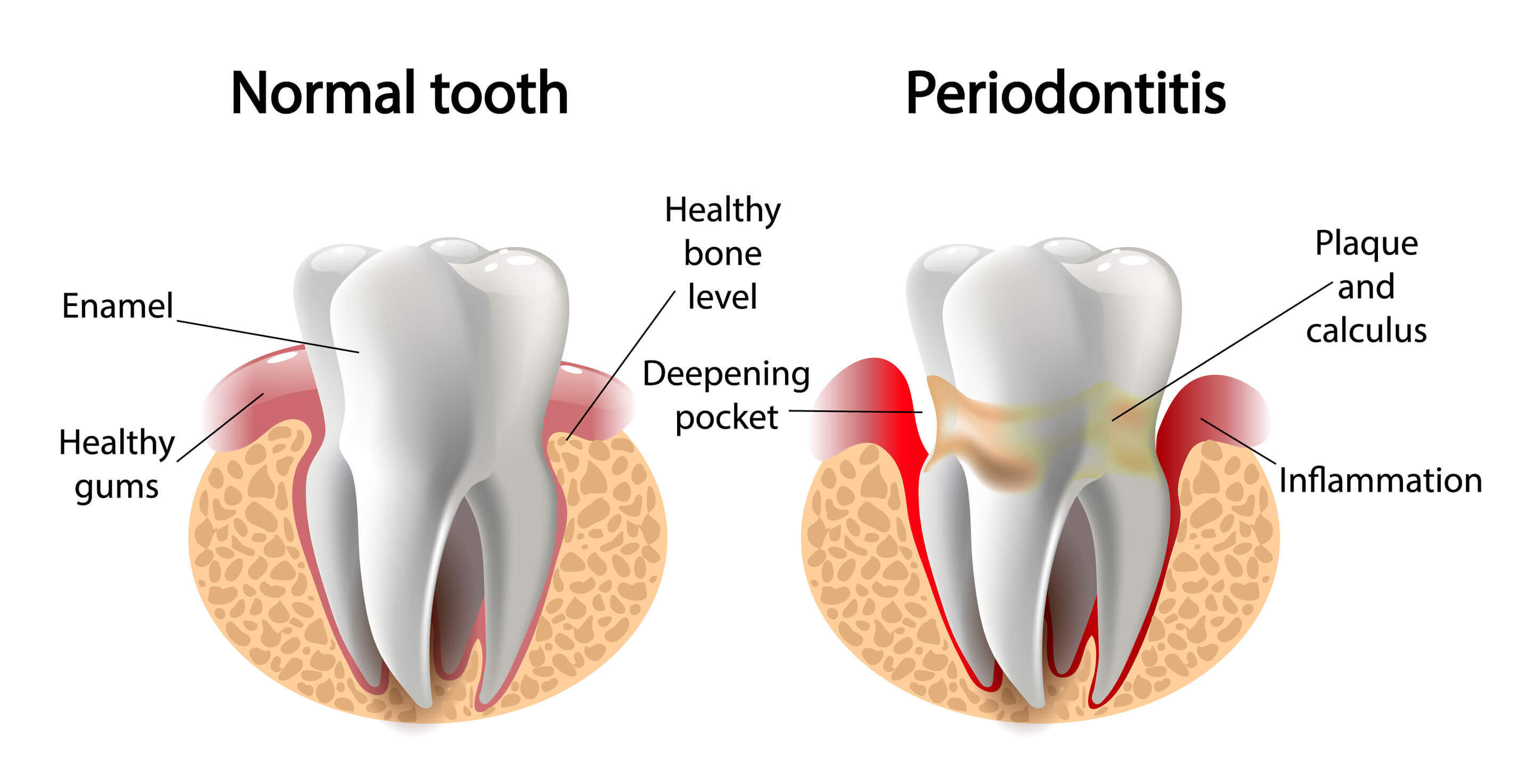 How-Does-Periodontitis-Occur