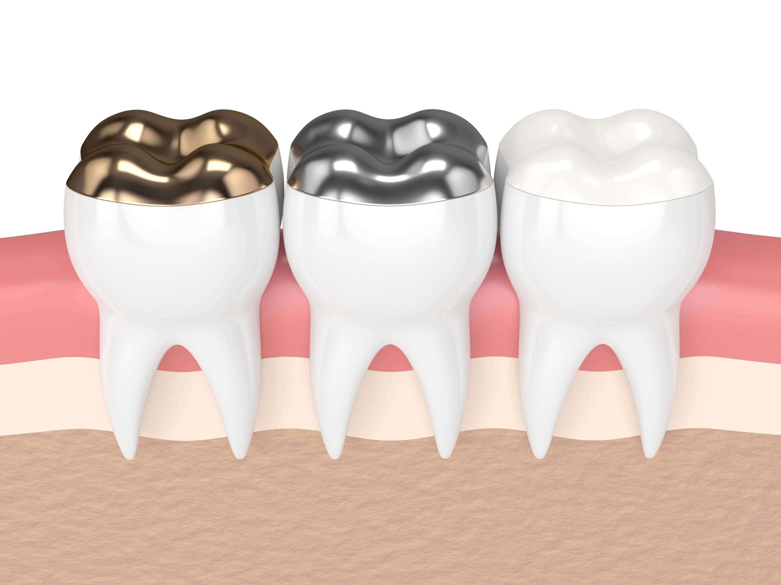 Silver and gold fillings on a 3D rendering of some teeth.