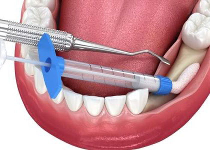 Dental procedure illustration, showing tools and syringe.