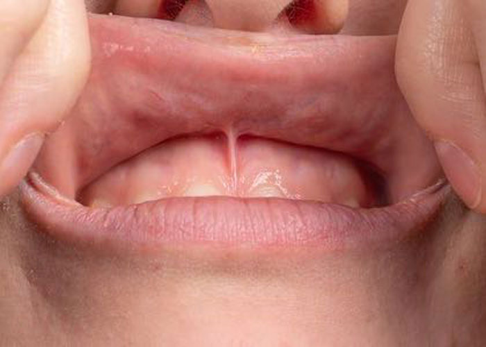 Close-up of upper lip frenulum examination.