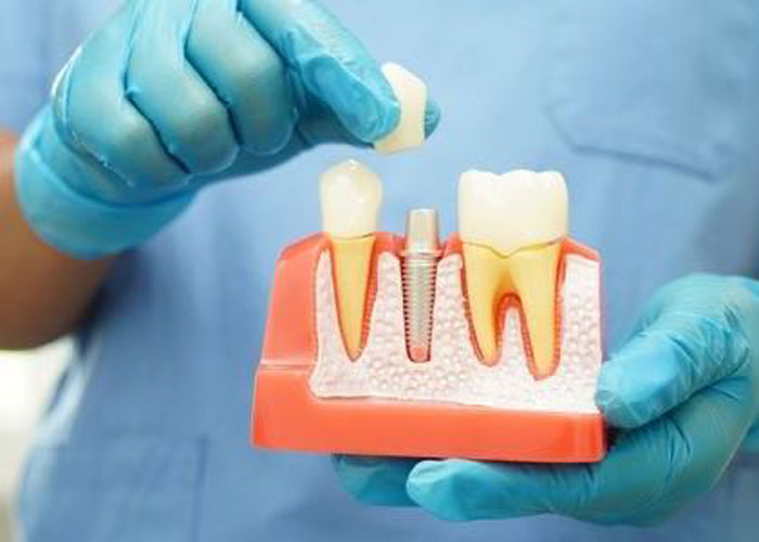Dental implant model demonstration by gloved hands.