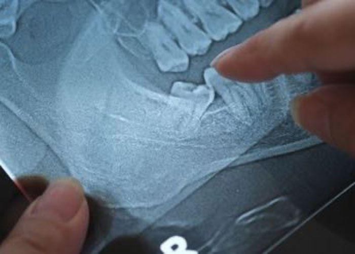 Dental X-ray showing impacted wisdom tooth